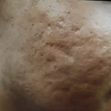 ジュブゼン施術前 ニキビ跡 症例写真