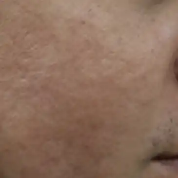 ジュブゼン施術4年6ヶ月後 ニキビ跡 改善症例