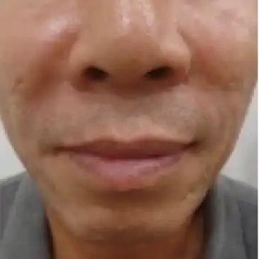 ジュブゼン施術5年後 深いしわ ほうれい線 改善症例