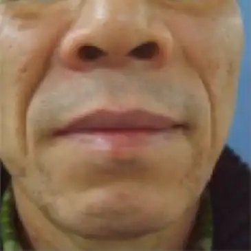 ジュブゼン施術前 深いしわ ほうれい線 症例