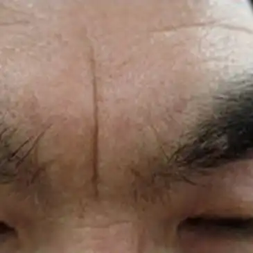 ジュブゼン施術前 眉間のしわ 症例写真
