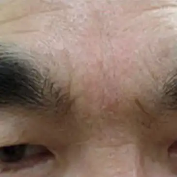 ジュブゼン施術5年後 眉間のしわ 改善症例