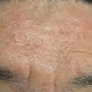 ジュブゼン施術3年後 おでこのしわ 改善症例