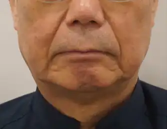 ジュブゼン開発者本人 施術前 深いしわ 症例